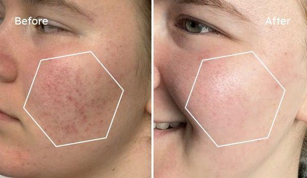 Brooke transformation